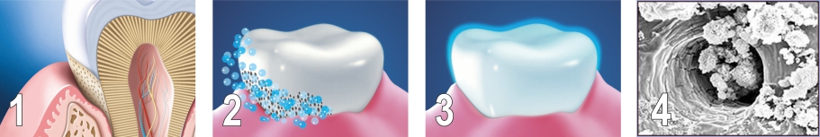 этапы отбеливания чувствительных зубов