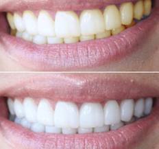 эффективность действия геля для отбеливания зубов PearlSmile